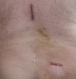 Photo of incision sites